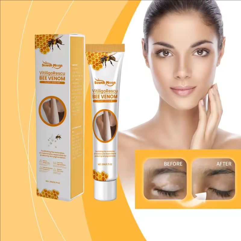 Vitiligo Relief Cream Leukoplakia Mycosis Soothing Ointment Remove White Spots Promote Melanin Production Moisturizing Skin Care