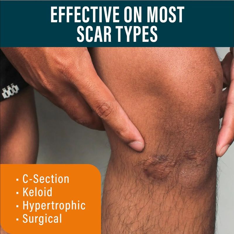 Advanced Recovery Scar Cream Fast Removal Skin Scars Treat Surgery Scars Stretch Marks Acne Pox Prints Burn Repair Gel