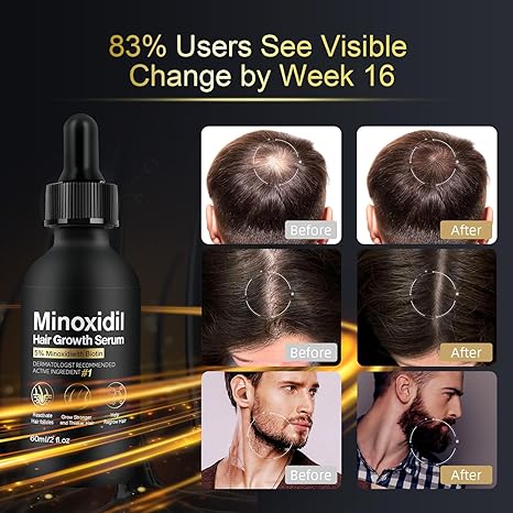 5% Minoxidil for Men & Women Hair Growth, Beard Growth, Hair Loss Treatment, Unisex Adult, Unscented Foam（60ML）
