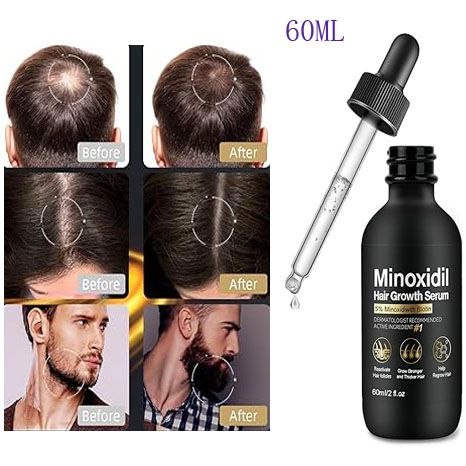 5% Minoxidil for Men & Women Hair Growth, Beard Growth, Hair Loss Treatment, Unisex Adult, Unscented Foam（60ML）