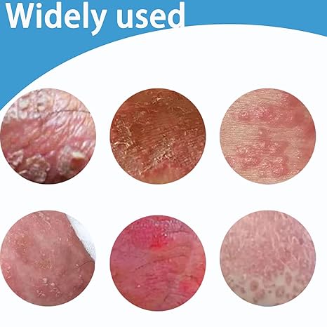 Chinese Herbal Relief Cream - Soothing and moisturizing, Rapid External Hemorrhoids Treat，For treatment of yeast infection, diabetes, allergy, other skin diseases, hormone changes and skin diseases
