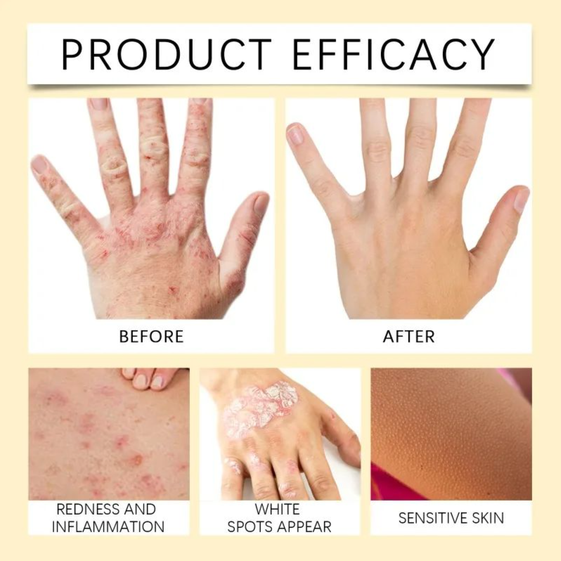 Bee Venom Vitiligo Treatment Cream Natural Relief Skin Treatment Soothing White Spot Removal Vitiligo Ointment Eliminate Pigment