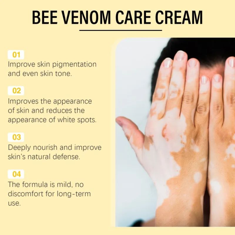 Bee Venom Vitiligo Treatment Cream Natural Relief Skin Treatment Soothing White Spot Removal Vitiligo Ointment Eliminate Pigment