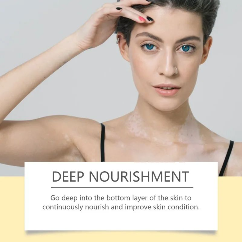 Bee Venom Vitiligo Treatment Cream Natural Relief Skin Treatment Soothing White Spot Removal Vitiligo Ointment Eliminate Pigment