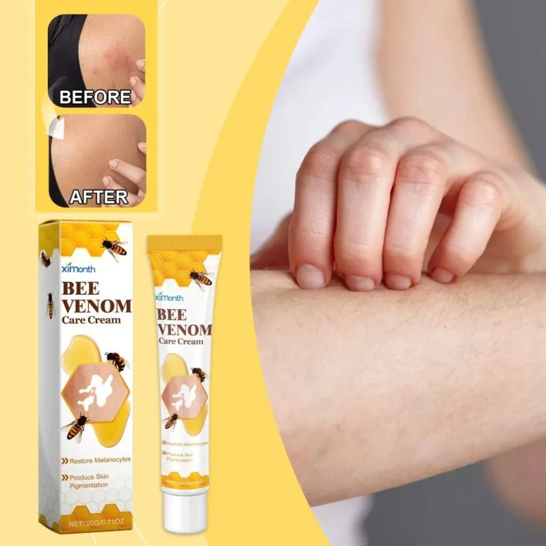 Bee Venom Vitiligo Treatment Cream Natural Relief Skin Treatment Soothing White Spot Removal Vitiligo Ointment Eliminate Pigment