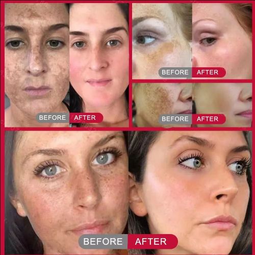 Whitening Freckles Face Cream Removal Melasma Dark Spots Corrector Lighten Melanin Pigmentation Brighten Anti-Aging Beauty Care