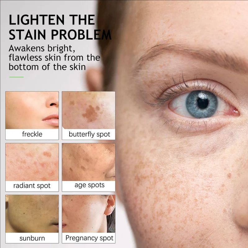 Whitening Freckles Cream Face Remove Melasma Dark Spots Lighter Melanin Melasma Remover Moisturizing Fleur Skin Care 30Ml