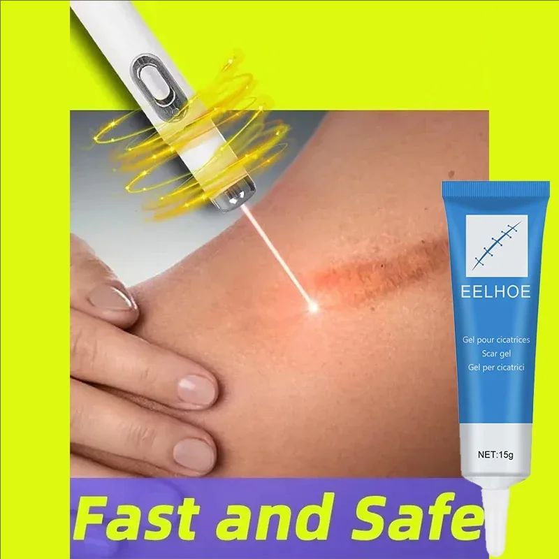 High Effect Laser Pen Therapy Keloid Scar Repair Cream Reduces Hyperplasia Pregnancy Surgery Burn Scar Skin Repair Cream