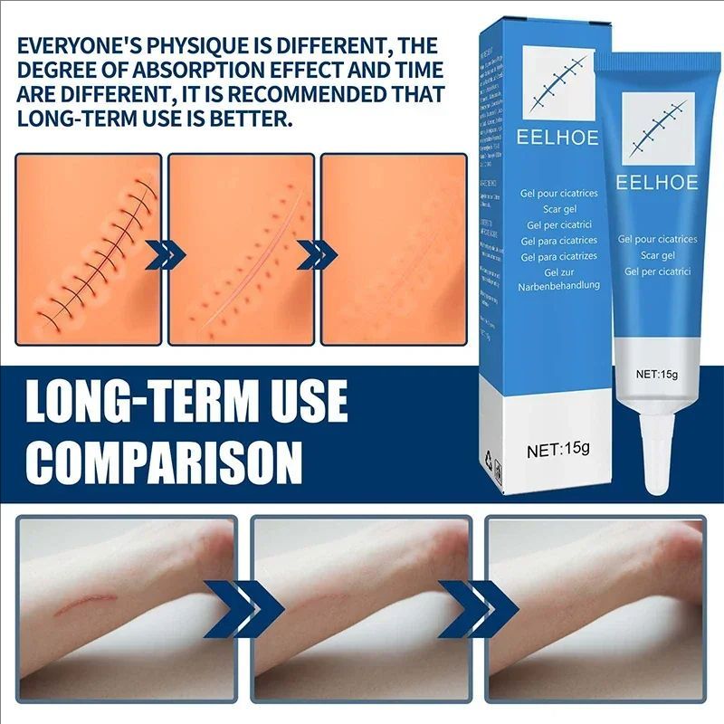 High Effect Laser Pen Therapy Keloid Scar Repair Cream Reduces Hyperplasia Pregnancy Surgery Burn Scar Skin Repair Cream