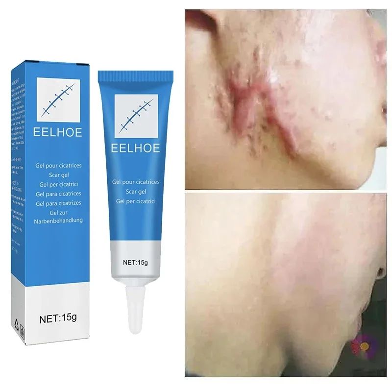 High Effect Laser Pen Therapy Keloid Scar Repair Cream Reduces Hyperplasia Pregnancy Surgery Burn Scar Skin Repair Cream