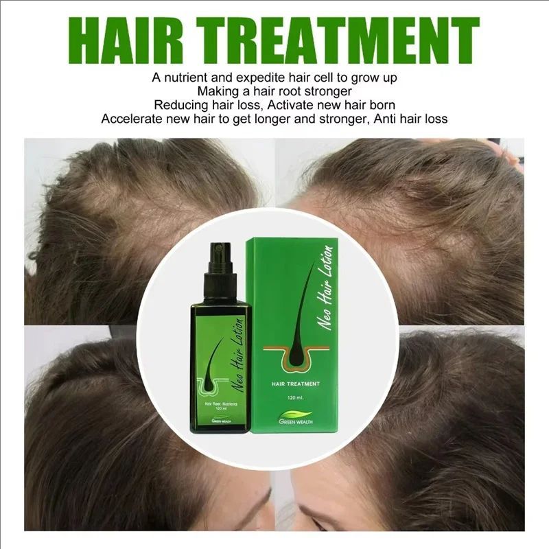 Hair Care Lotion 120 ml Hair Regrowth Treatment Growth Strengthens Damaged Hair Loss Revitalizes Scalp For Men & Women