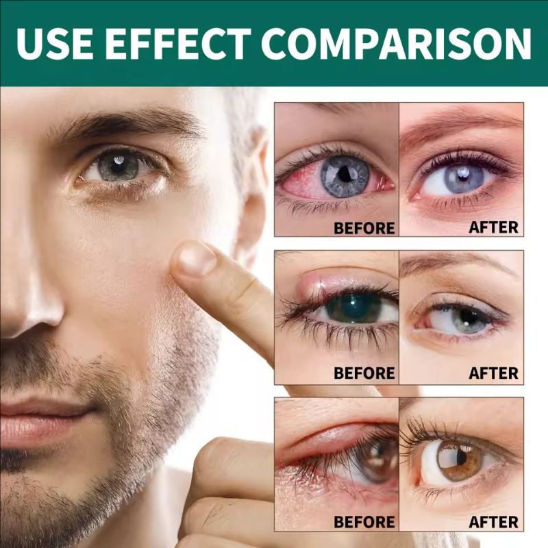 Anti-Fatigue Eye Liquid Blurred Vision Discomfort Treatment Swelling Dry Eyes Itching Cloudy Eyeball Cleaning Eyesight Health