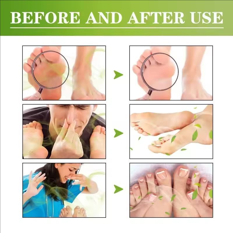 Athletes Foot spray Beriberi Cream Deodorant remove Odor Dry Crack peeling Anti itch sweat feet moisturizing skin fragrance Care
