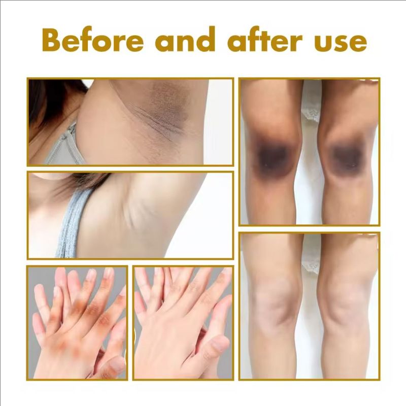 Peeling Oil Bleach Dark Skin Exfoliate Arm Elbow Knee Leg Dead Skin Remove Joint Melanin Dark Knuckles Removal Pigment Corrector