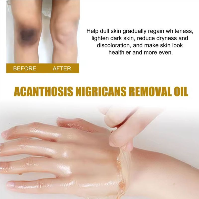 Peeling Oil Bleach Dark Skin Exfoliate Arm Elbow Knee Leg Dead Skin Remove Joint Melanin Dark Knuckles Removal Pigment Corrector