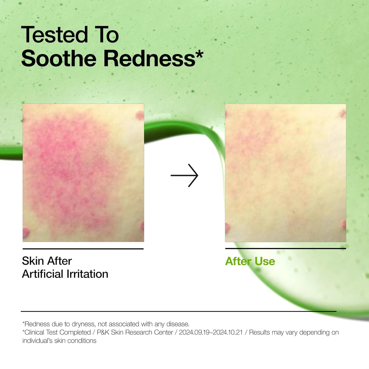 Anua 10+ Azelaic Acid 10 + Hyaluron Serum. Hydrates, Treats & Calms Acne, Rosacea, Soothes Redness & Irritations, Fades Acne Marks, Hyperpigmentations, Spots, Smooths, Soften, Evens Skin Tone & Glows