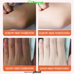 SADOER 2pcs Whitening Dark Knuckle Set – Cream + Serum with Niacinamide & Vitamin C