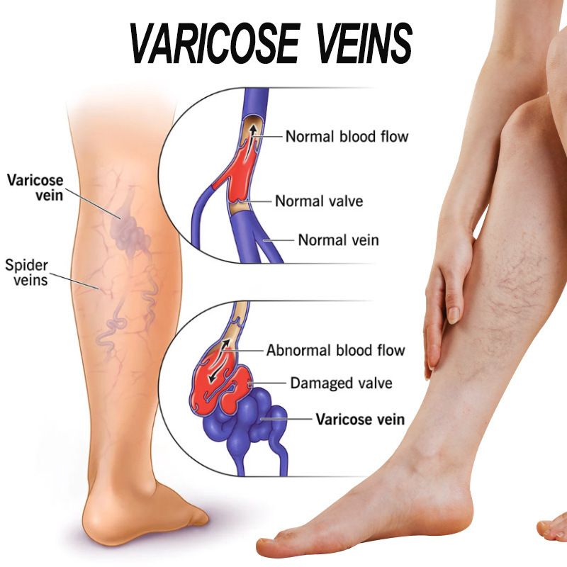 Varicose Veins Treatment Cream For Relief Of Varicose Veins, Spider Veins, Vasculitis, Leg Swelling, Pain, Fatigue, Improved Circulation And Smoother Skin Care