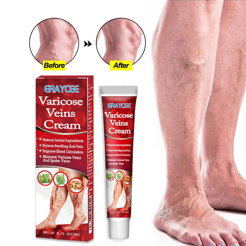 Varicose Veins Treatment Cream For Relief Of Varicose Veins, Spider Veins, Vasculitis, Leg Swelling, Pain, Fatigue, Improved Circulation And Smoother Skin Care