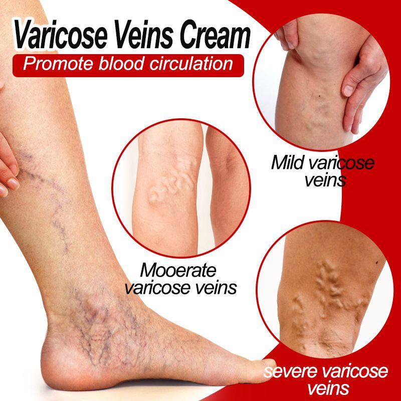 Varicose Veins Treatment Cream For Relief Of Varicose Veins, Spider Veins, Vasculitis, Leg Swelling, Pain, Fatigue, Improved Circulation And Smoother Skin Care