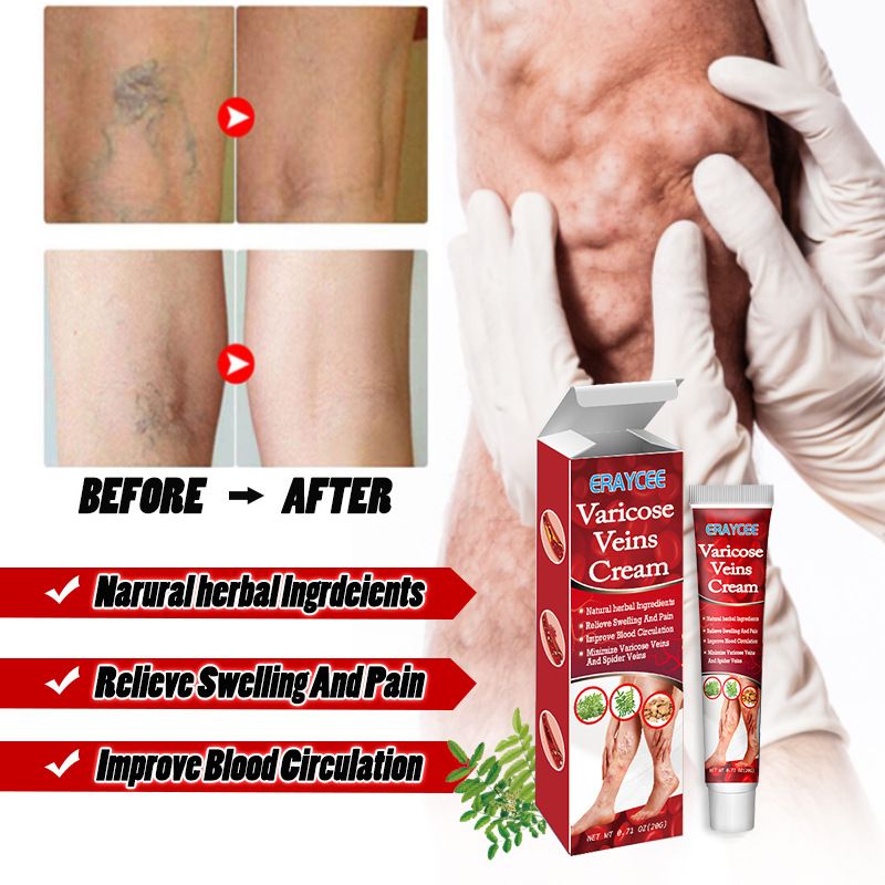 Varicose Veins Treatment Cream For Relief Of Varicose Veins, Spider Veins, Vasculitis, Leg Swelling, Pain, Fatigue, Improved Circulation And Smoother Skin Care
