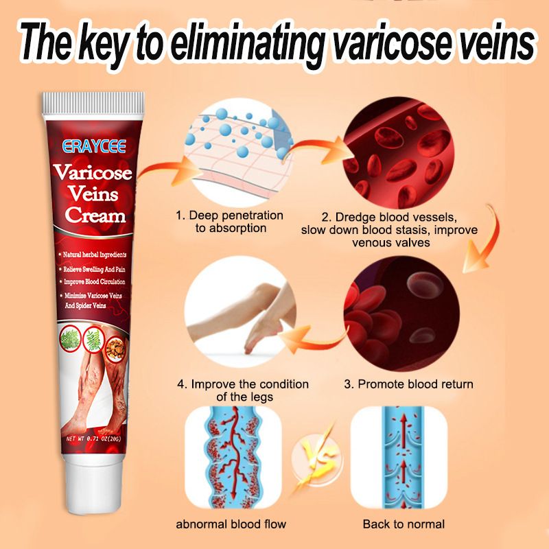 Varicose Veins Treatment Cream For Relief Of Varicose Veins, Spider Veins, Vasculitis, Leg Swelling, Pain, Fatigue, Improved Circulation And Smoother Skin Care