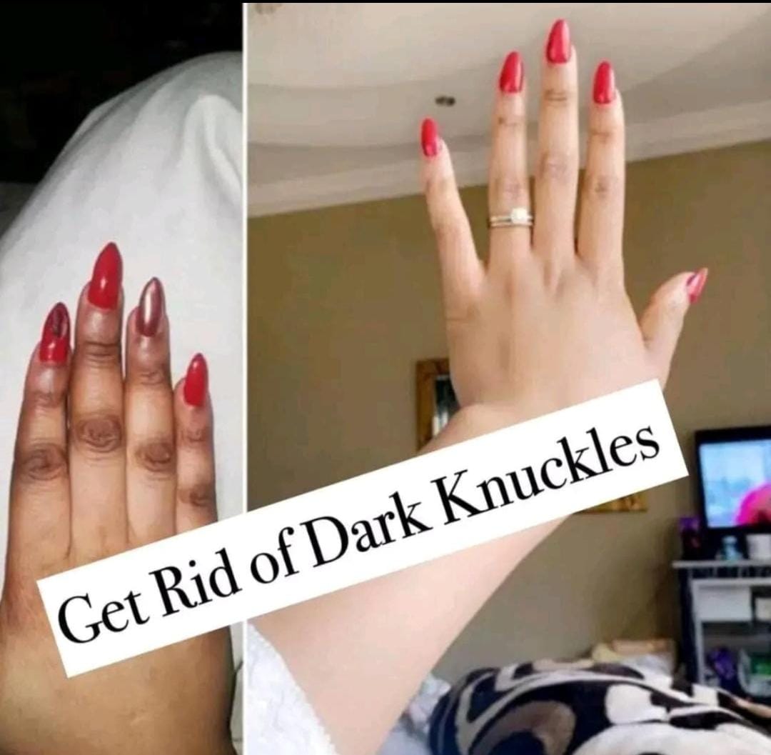 Kennite Knuckles Gel Fast Action Cream For Whitening Dark Knuckles, Elbows, Knees & Spots – Visible Results In 5 DaysPowerful Brightening Gel That Fades Dark Knuckles, Evens Skin Tone