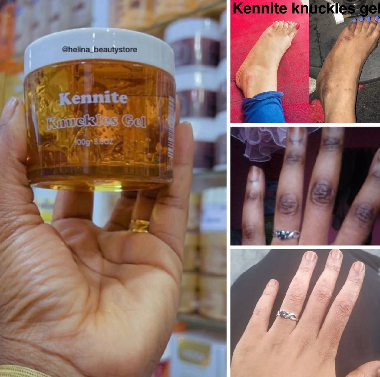 Kennite Knuckles Gel Fast Action Cream For Whitening Dark Knuckles, Elbows, Knees & Spots – Visible Results In 5 DaysPowerful Brightening Gel That Fades Dark Knuckles, Evens Skin Tone