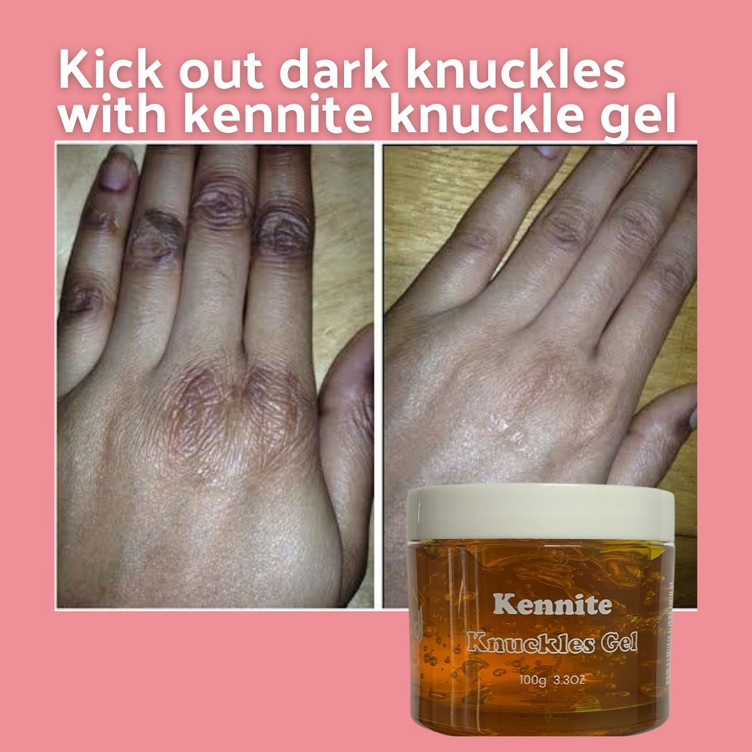 Kennite Knuckles Gel Fast Action Cream For Whitening Dark Knuckles, Elbows, Knees & Spots – Visible Results In 5 DaysPowerful Brightening Gel That Fades Dark Knuckles, Evens Skin Tone