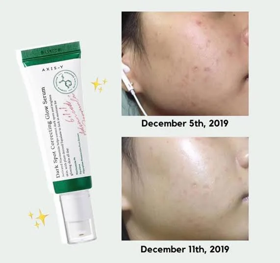 AXIS-Y Dark Spot Correcting Glow Serum With Niacinamide & Squalane Brightens, Evens Skin Tone & Fades Dark Spots For A Radiant Glow