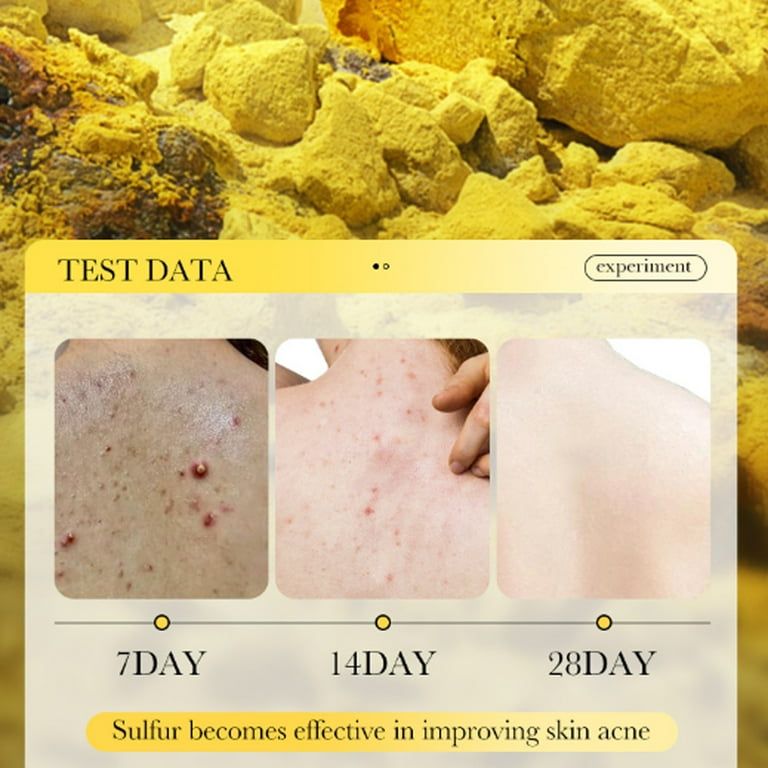 Sadoer Sulfur Cleaning Repair Multi-Action 3 In 1 Acne Soap 125g