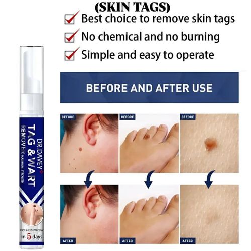 dr davey NEW ADVANCED MAXIMUM STRENGTH TAG & WART REMOVER 16ML