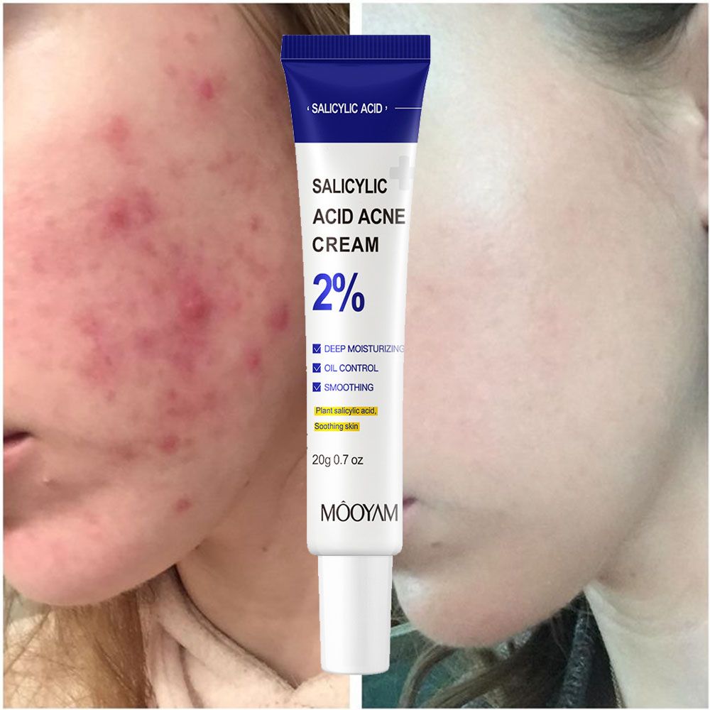 MOOYAM Salicylic Acid Acne Cream Fast Repair Pimple Scar 2% Salicylic Acid Anti Spots Removal Gel Smoothing Body Face Skin Shrink Pores Cream