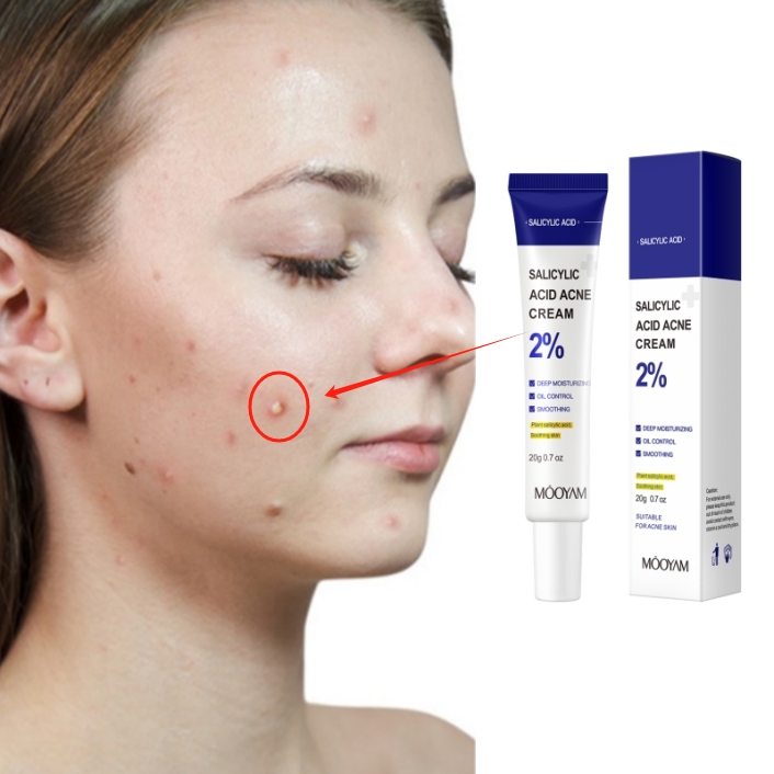 MOOYAM Salicylic Acid Acne Cream Fast Repair Pimple Scar 2% Salicylic Acid Anti Spots Removal Gel Smoothing Body Face Skin Shrink Pores Cream