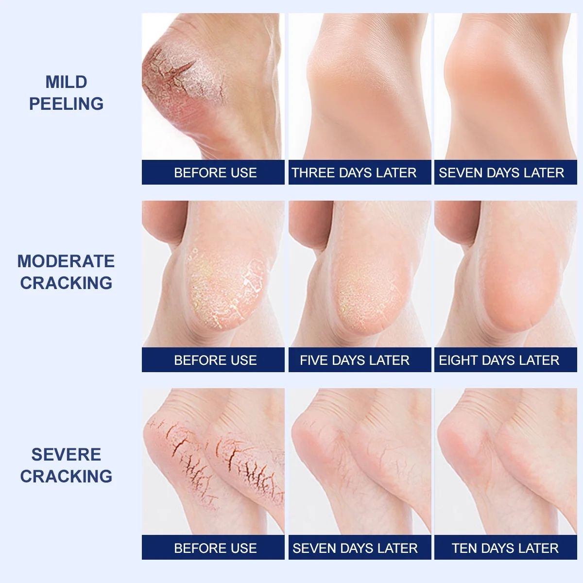 Mooyam 42% Urea Cream 2% Salicylic Acid Foot Cream Hand Lotion for Rough Dry Cracked Skin - Callus Dead Skin Remover and Moisturizer with Jojoba Oil, Avocado Oil, Aloe Vera