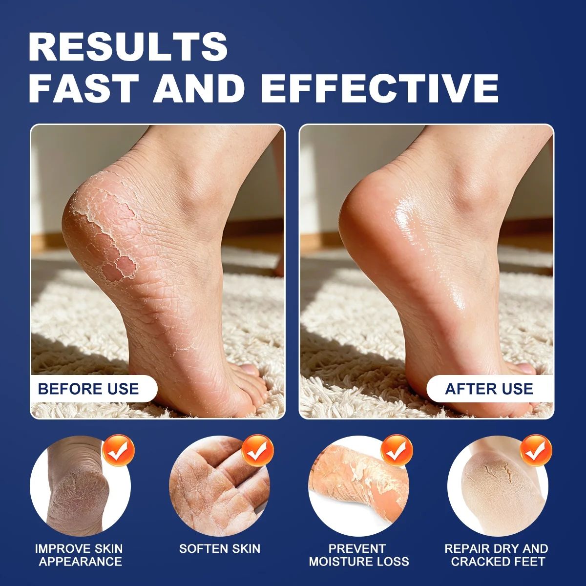 Mooyam 42% Urea Cream 2% Salicylic Acid Foot Cream Hand Lotion for Rough Dry Cracked Skin - Callus Dead Skin Remover and Moisturizer with Jojoba Oil, Avocado Oil, Aloe Vera