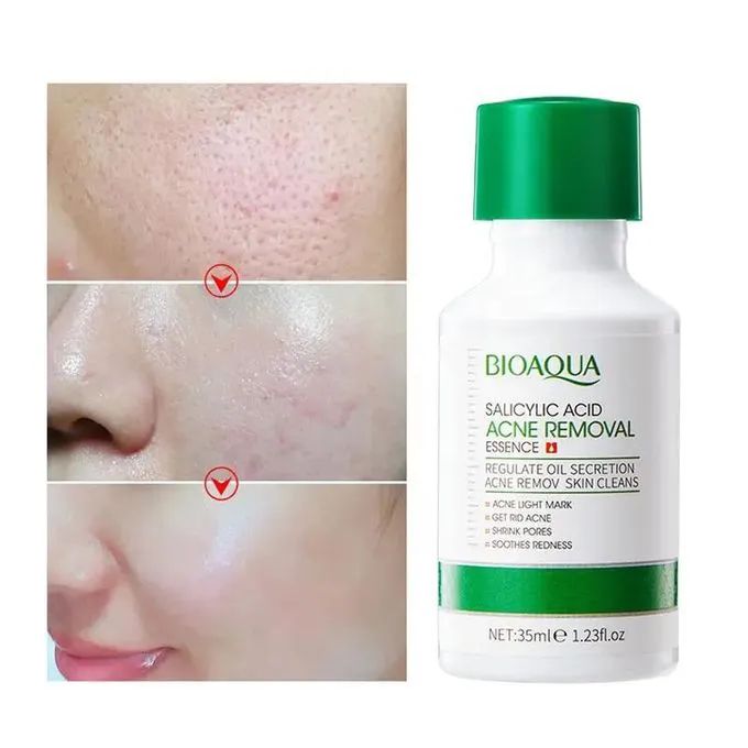 3 in 1 BIOAQUA Salicylic Acid Acne Treatment, Oil Control Combo, Salicylic Cleanser + Salicylic Essence + Cream Fades Acne Marks, Eliminates Pimples, Soothes, Shrinks Pores Black Heads, Pimples set