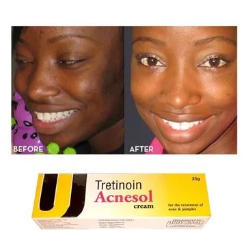 Tretinoin Acnesol Cream Treats Acne & Pimples