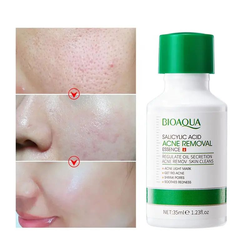 Bioaoua 2 Pieces Acne Removal Essence + Salicylic Acid Face Wash, For Facial Cleanser, Acne treatment, Shrink Pores, Sooth Redness, Eradicate Acne Marks, Can Use Vitamin C Together, Skin Smoothening