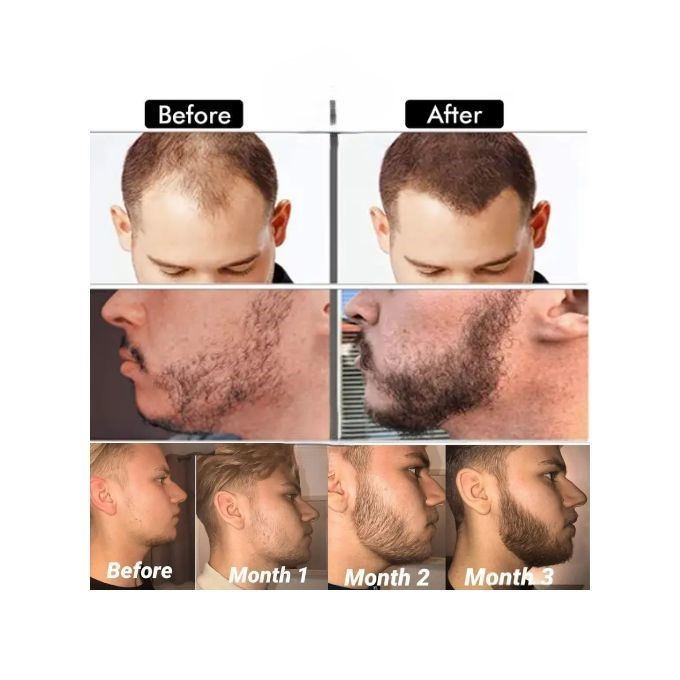 Derma Roller 0.3mm 2.0mm DERMAROLLER MICRO NEEDLE BEARD HAIR SKIN FACE WRINKLE & ANTI-AGING DERMA