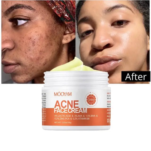 ACNE  FACE REMOVAL CREAM FAST VEGAN  EFFECTIVE FACE CARE CLEARS ACNE AND BLACK HEADS LACTIC ACID INFUSED MOISTURIZER FIRMING CREAM SHRINKS PORES NOURISHES SKIN SKIN REVITALIZER