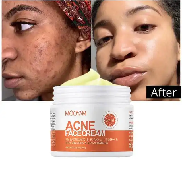 ACNE  FACE REMOVAL CREAM FAST VEGAN  EFFECTIVE FACE CARE CLEARS ACNE AND BLACK HEADS LACTIC ACID INFUSED MOISTURIZER FIRMING CREAM SHRINKS PORES NOURISHES SKIN SKIN REVITALIZER