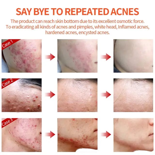 ACNE  FACE REMOVAL CREAM FAST VEGAN  EFFECTIVE FACE CARE CLEARS ACNE AND BLACK HEADS LACTIC ACID INFUSED MOISTURIZER FIRMING CREAM SHRINKS PORES NOURISHES SKIN SKIN REVITALIZER