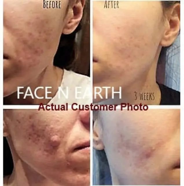 ACNE  FACE REMOVAL CREAM FAST VEGAN  EFFECTIVE FACE CARE CLEARS ACNE AND BLACK HEADS LACTIC ACID INFUSED MOISTURIZER FIRMING CREAM SHRINKS PORES NOURISHES SKIN SKIN REVITALIZER