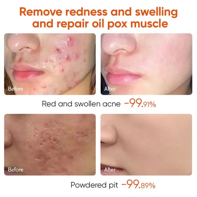 ACNE  FACE REMOVAL CREAM FAST VEGAN  EFFECTIVE FACE CARE CLEARS ACNE AND BLACK HEADS LACTIC ACID INFUSED MOISTURIZER FIRMING CREAM SHRINKS PORES NOURISHES SKIN SKIN REVITALIZER