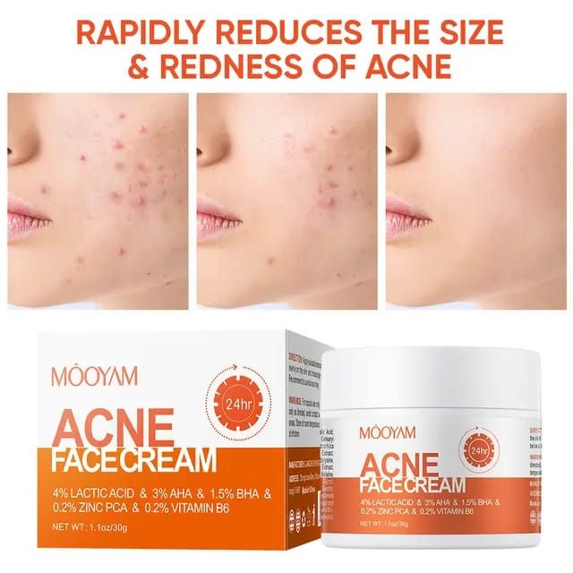 ACNE  FACE REMOVAL CREAM FAST VEGAN  EFFECTIVE FACE CARE CLEARS ACNE AND BLACK HEADS LACTIC ACID INFUSED MOISTURIZER FIRMING CREAM SHRINKS PORES NOURISHES SKIN SKIN REVITALIZER