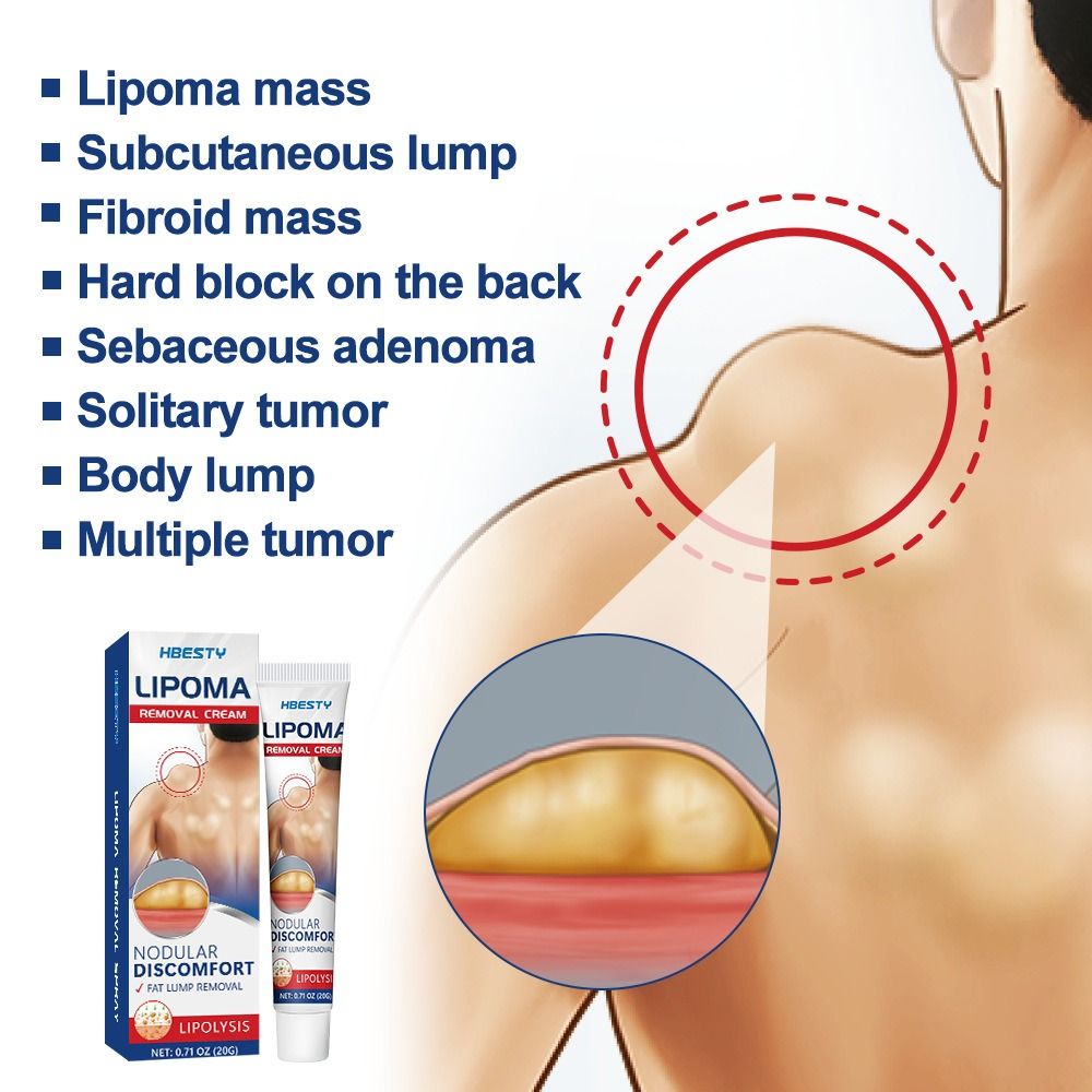 Fat Jie Xiao Gao relieve Fat caking Fat granules subcutaneous lump Protrusion Dispersal cream