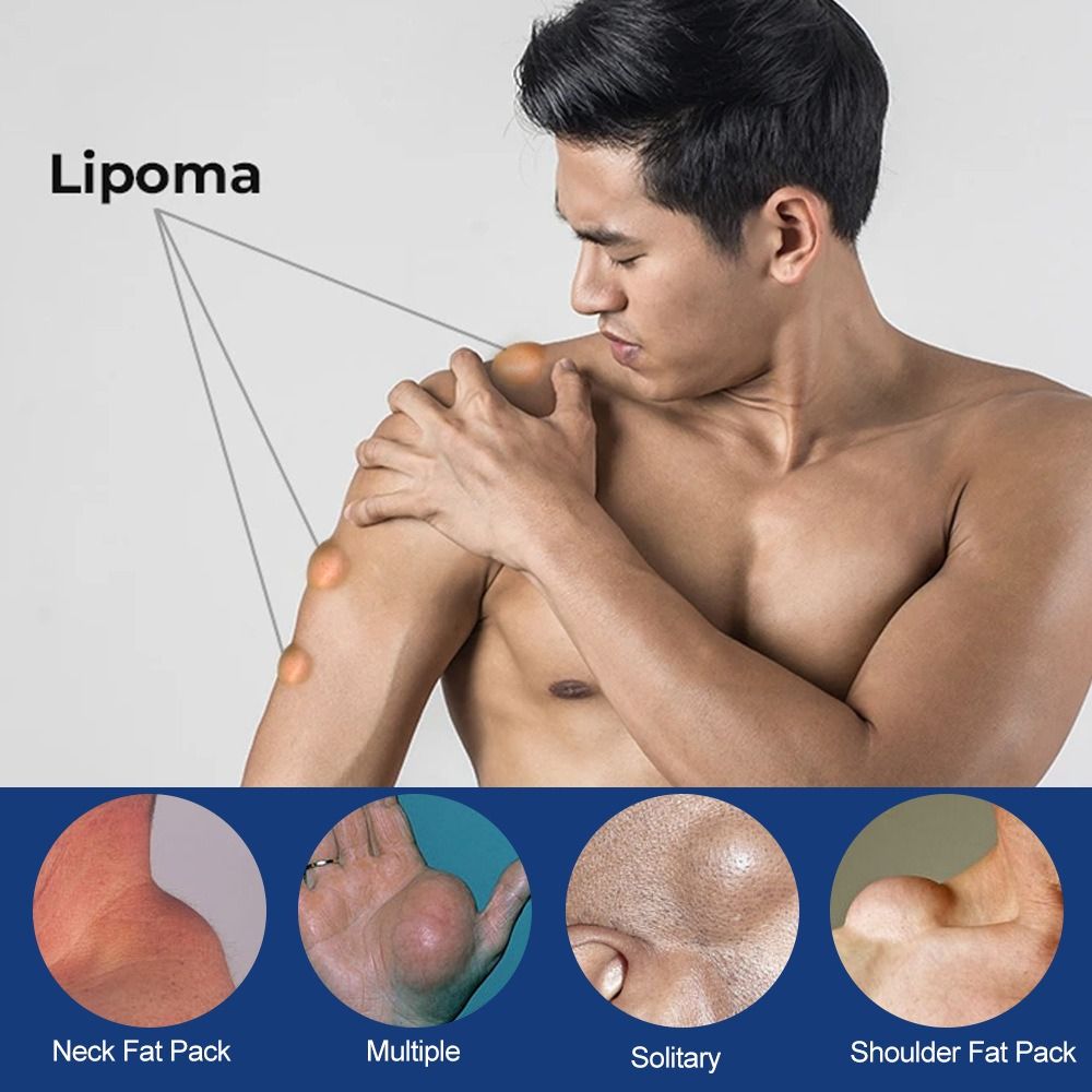 Fat Jie Xiao Gao relieve Fat caking Fat granules subcutaneous lump Protrusion Dispersal cream