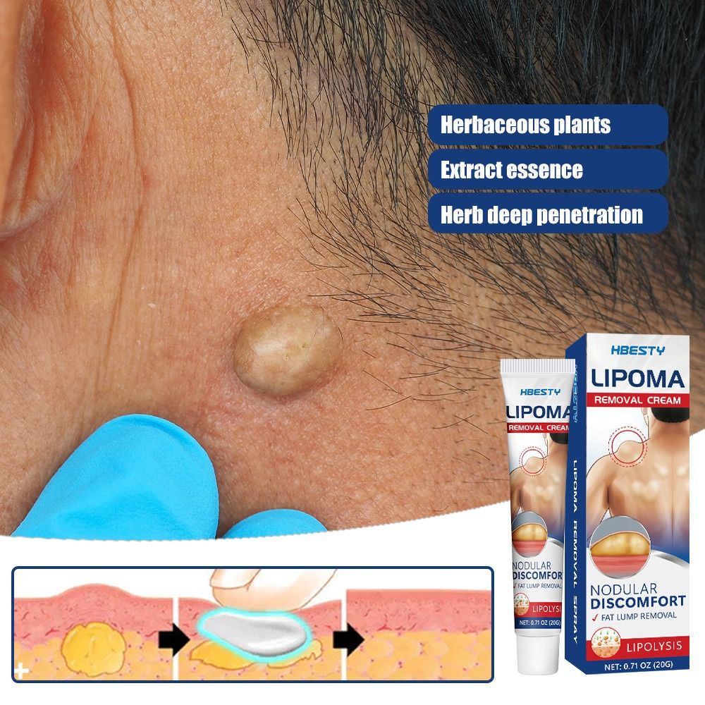 Fat Jie Xiao Gao relieve Fat caking Fat granules subcutaneous lump Protrusion Dispersal cream