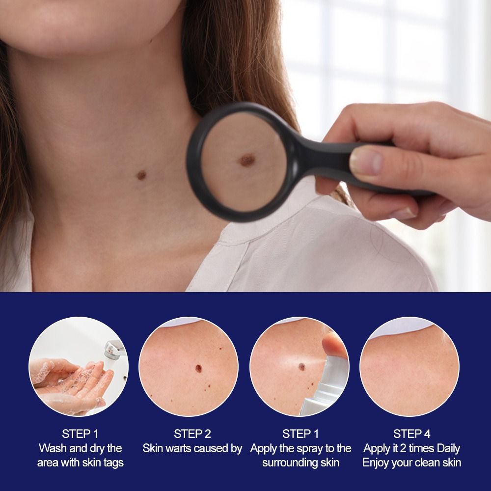 Wart removing spray Wart flat Nursing solution Chicken eye diced meat Fat granules Nursing repair fluid